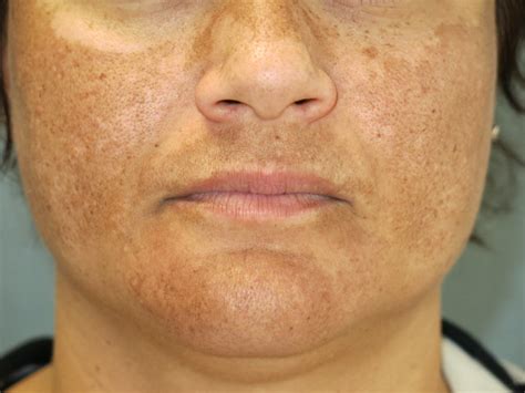 Melasma – Arlington Skin Doctor