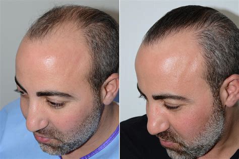 Hair Transplants for Men photos | Miami, FL | Patient59522