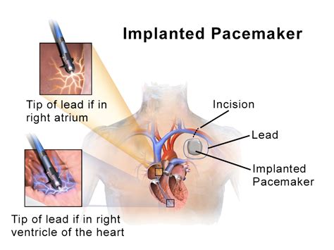 Pacemaker/AICD Interrogation — Dr. Mohin, MD