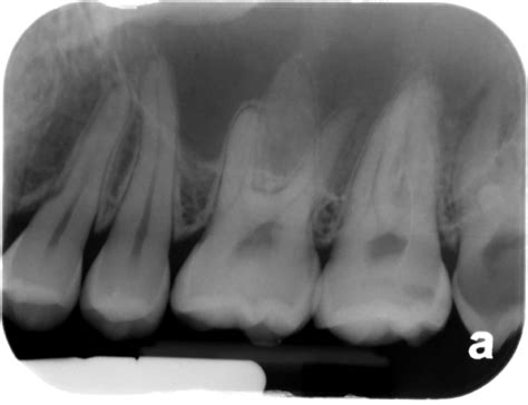 Enamel Pearl – Dr. G's Toothpix