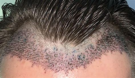 What You Need To Know About Shedding After A Hair Transplant ...