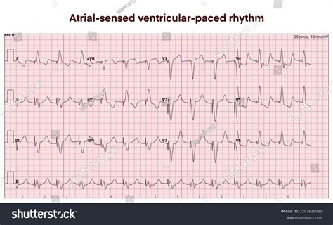 Electrocardiogram Show Atrial- Sensed Ventricular-paced Rhythmasvp ...