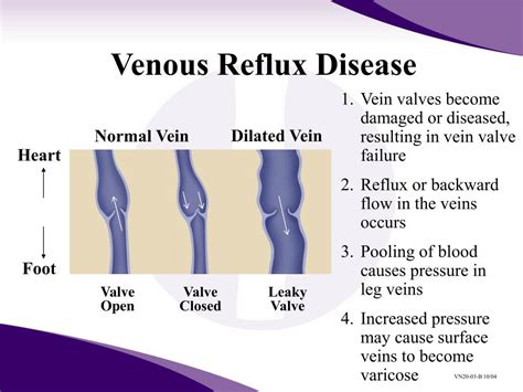 PPT - Venous Reflux Disease and Current Treatment Modalities PowerPoint Presentation - ID:264659