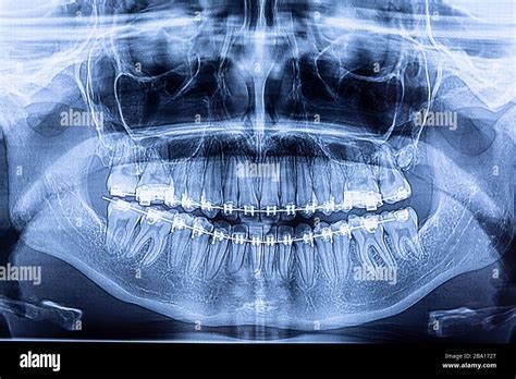 Dental x-ray with braces. Radiography for teeth straightening and ...