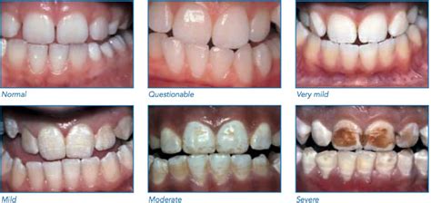 Dental fluorosis causes, prevention, symptoms & dental fluorosis treatment