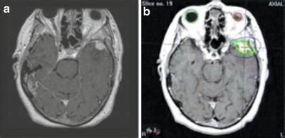 Meningioma | Radiology Key