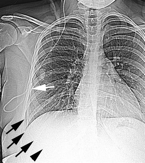 Ventriculo-Pleural Shunt | The Neurosurgical Atlas