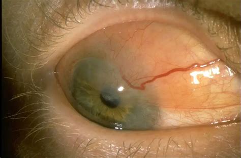 Conjunctival lymphoma - American Academy of Ophthalmology