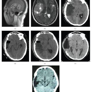 Imaging results for Case 2. (a)-(b) MRI showing sphenoid ridge... | Download Scientific Diagram