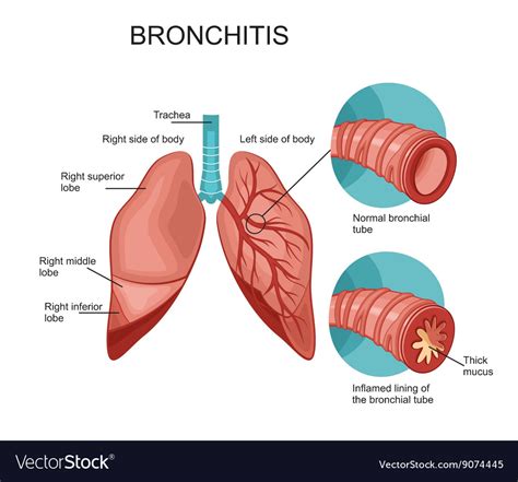 Bronchitis Royalty Free Vector Image - VectorStock