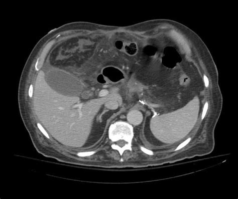 Omental infarction | Radiology Case | Radiopaedia.org Ct Scan, Case, Radiology