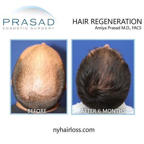 Hair Regeneration - Non-Surgical Hair Transplant Alternative