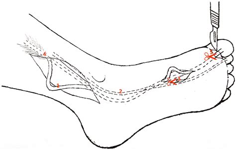 Minimally invasive technique (1). FHL tendon, (2). FDL tendon, (3).... | Download Scientific Diagram