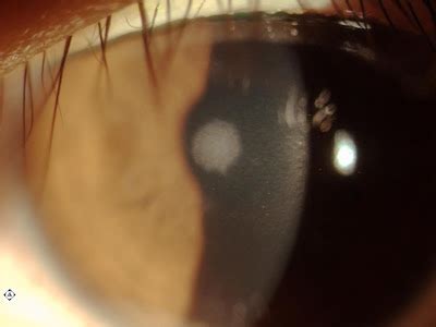 Sonoran Desert Eye Center: SCAR ON CORNEA FROM ULCER RELATING FROM CONTACT LENS OVERWEAR