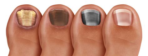 White Discoloration On Toenails After Nail Polish - Nail Ftempo