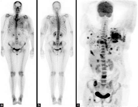 Whole body bone scan of a patient with LABC in anterior (a) and... | Download Scientific Diagram