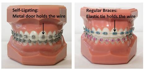 Self-Ligating: Damon®, Speed™, or In-Ovation® Braces - Granger ...