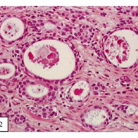 Low-grade papillary urothelial carcinoma associated with an invasive ...