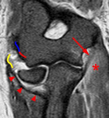 Lateral Ulnar Collateral Ligament Mri