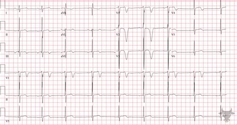 Hypertrophic Cardiomyopathy | ECG Stampede