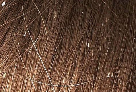 69 best images about Pictures of lice and nits on Pinterest