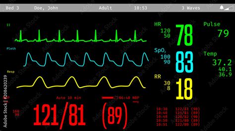 Monitoring of patient's condition, vital signs on ICU monitor in hospital. 3D illustration Stock ...