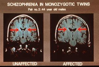 Schizophrenia.com - Schizophrenia is a Brain Disease