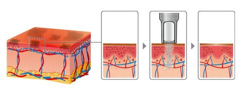 Melasma Treatment - Inkfree, MD Laser Clinic in Houston, TX