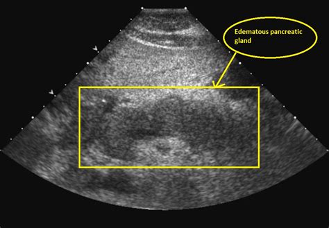 Acute pancreatitis ultrasound - wikidoc