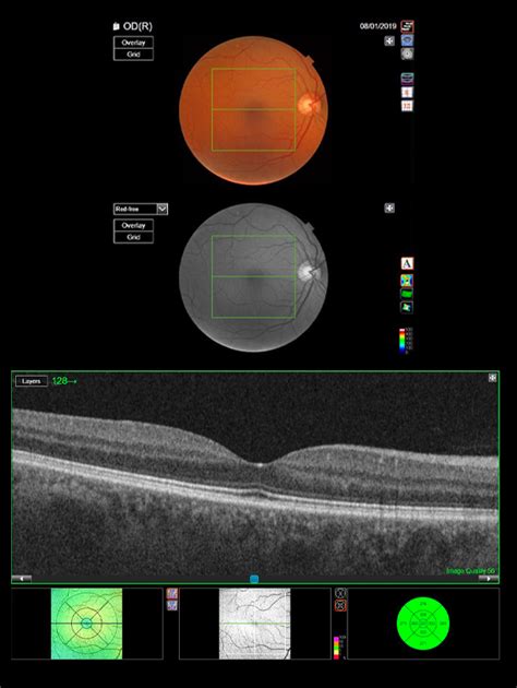 What is an OCT Scan? - Dipple & Conway