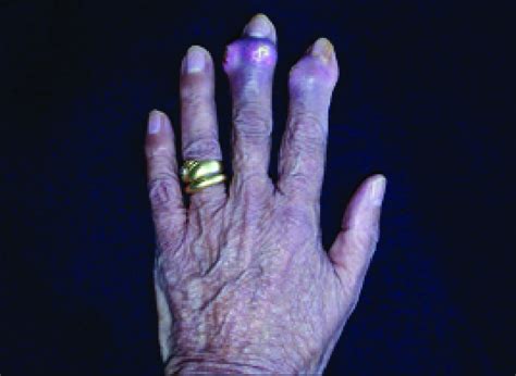 Chronic gout. Ulcerated tophi localized at the interphalangeal joints ...