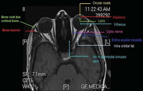 Orbit MRI Anatomy | Radiology Anatomy Images