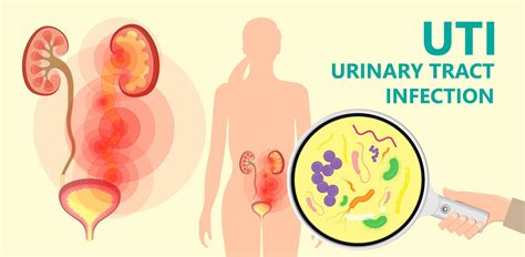 Female Urinary Tract Infection Home Treatment