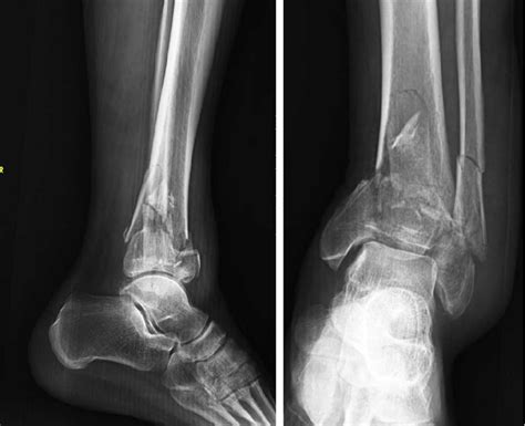 Pilon fracture before treatments by AP x-ray indicating tibia and... | Download Scientific Diagram