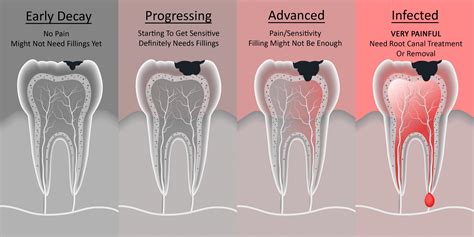 Tooth Decay - Berwick Dental Studio | Dentist Berwick | Invisalign ...