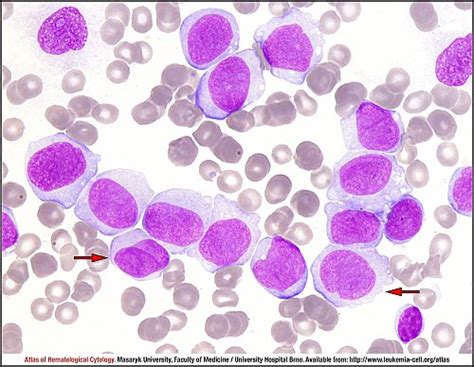 Acute monoblastic/monocytic leukaemia - CELL - Atlas of Haematological Cytology