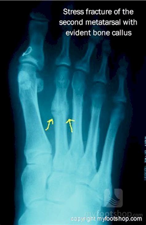 Metatarsal stress fracture | Treatment with a Spring Plate | MyFootShop.com