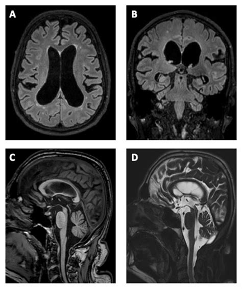 Brain MRI of the typical morphological changes associated with... | Download Scientific Diagram