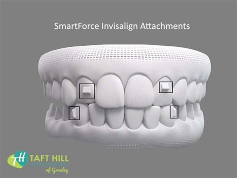 Invisalign Attachments Explained: how they work to help with your ...