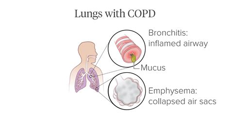 Pictures of COPD’s Effect on the Lungs