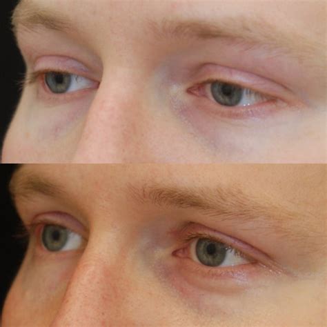 What do scars after eyelift (blepharoplasty) look like? — Lara Devgan ...