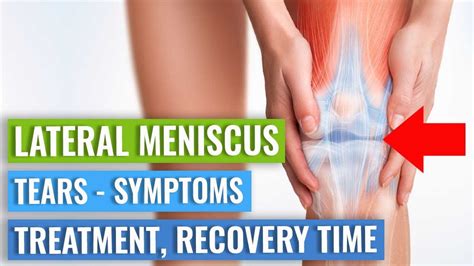 LATERAL Meniscus Tears: Symptoms, Treatment (Surgery vs. Exercise ...