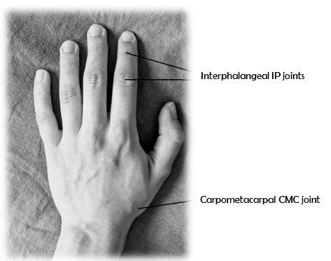 Osteoarthritis Hand | NHS Lanarkshire