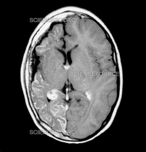 Photograph | MRI of Sturge-Weber Syndrome | Science Source Images