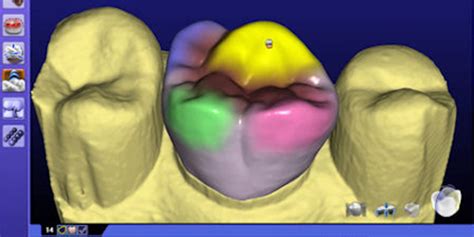 CAD CAM Crowns - Avant Dental