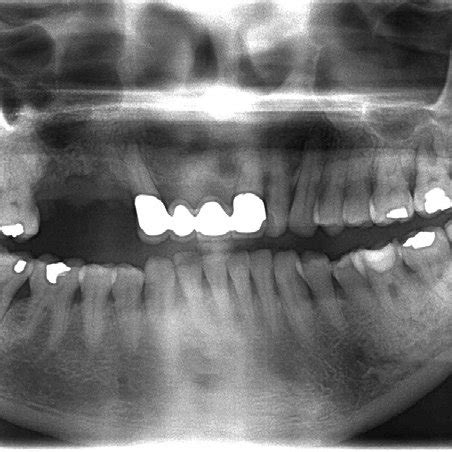 After six months, two implants (Nobel Biocare ® 3.5 × 11.5 mm and 4.3 ×... | Download Scientific ...