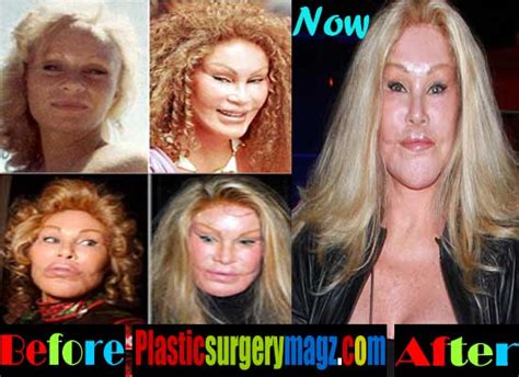 The Catwoman Plastic Surgery Before and After Pictures | Plastic Surgery Magazine