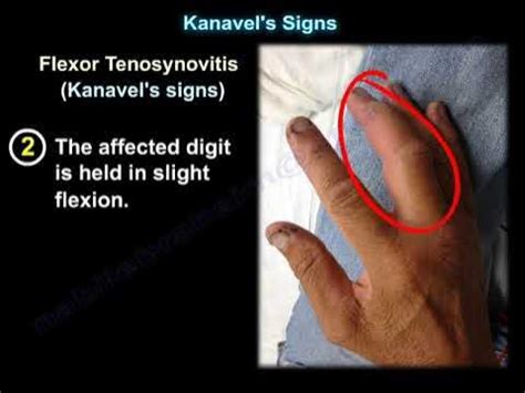 Kanavel's Signs, infection of the flexor tendons - YouTube