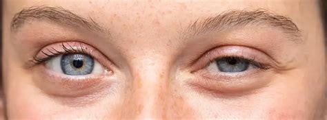 Droopy Eyelids – Causes and Treatments of Ptosis