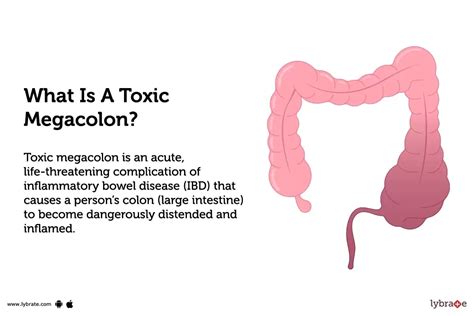 Toxic megacolon: Causes, Symptoms, Treatment and Cost